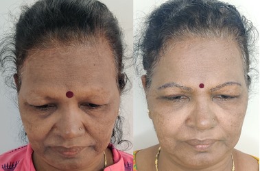 eyelid surgery